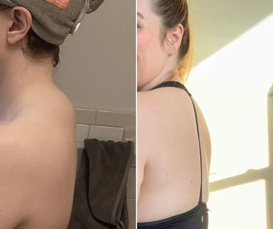 5-Celebrities-With-Buffalo-Humps-How-They-Got-Rid-of-It Callixe